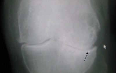 Dolor de Articulaciones